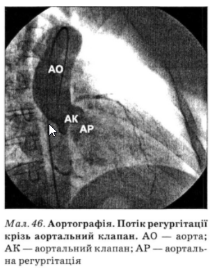 При виявленні протодіастолічного шуму над основою серця й уздовж лівого краю груднини насамперед проводять дифе­ренціальну діагностику