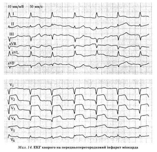 При передньобічному інфаркті міокарда прямі зміни ЕКГ ви являються у відведеннях I, aVL, V5 6, а при інфаркті міокарда в ділянці висо­ких відділів бічної стінки лівого шлуночка