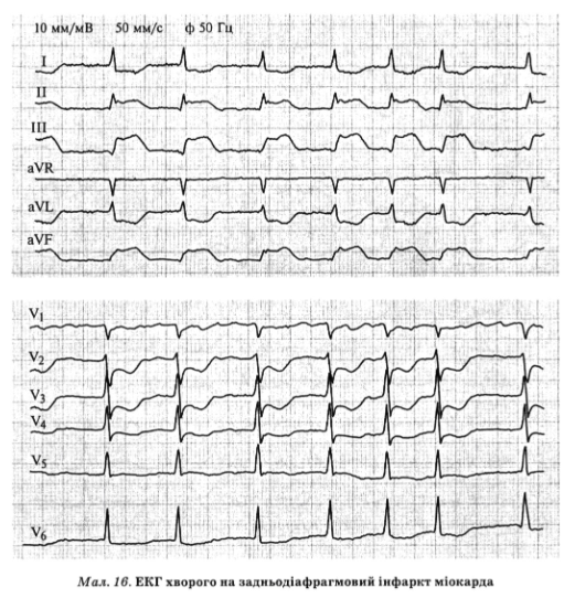 Прямі зміни ЕКГ при істинно задньому (задньобазальному) інфаркті міокарда у стандартних відведеннях не визначають­ся