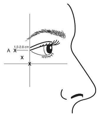 В іншому випадку, якщо зморшки у формі «гусячих лапок» знаходяться переважно нижче зовнішнього кута ока, зробіть ін’єкцію, як вказано