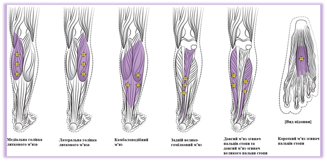 Нижче наведено діаграму з місцями для ін’єкцій при лікуванні спастичності нижніх кінцівок у дорослих.